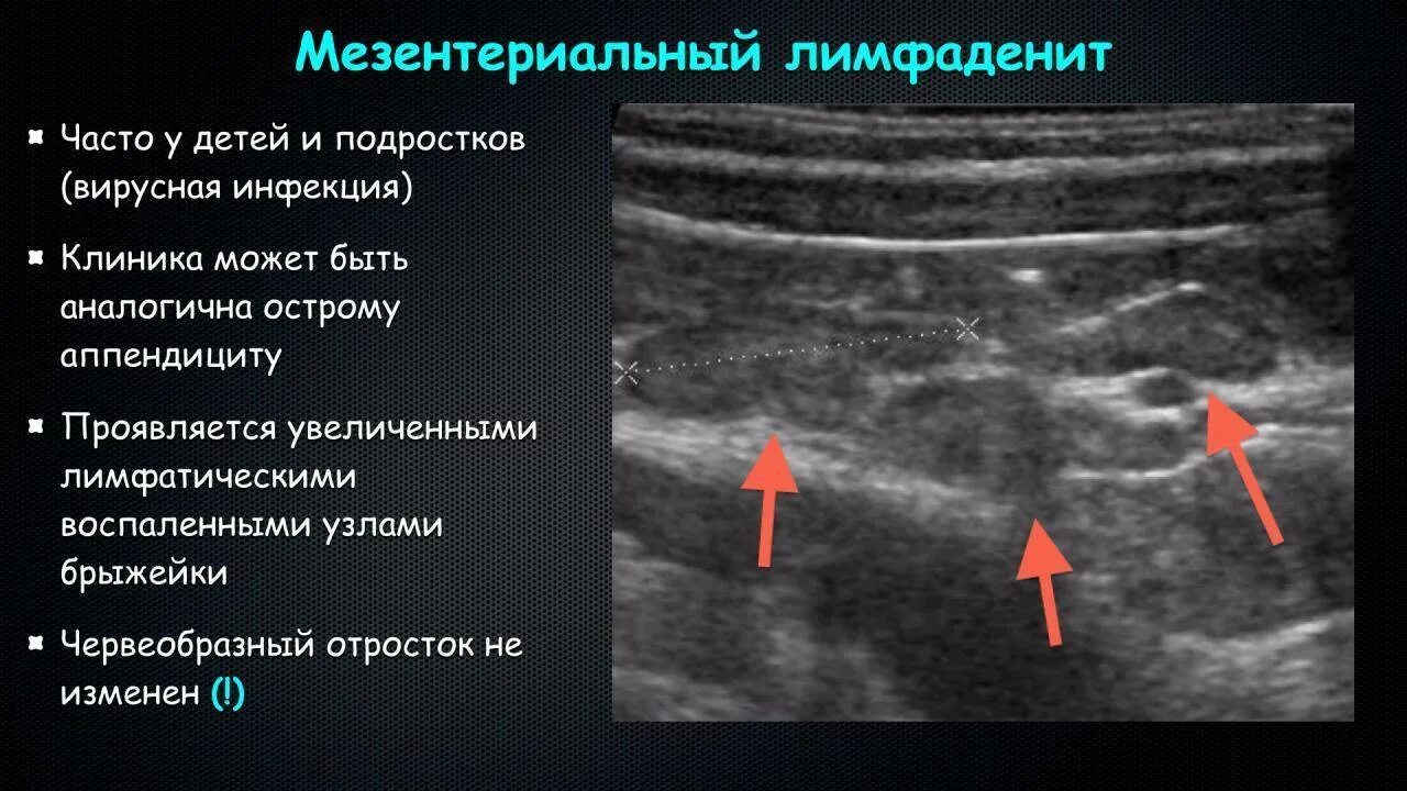 Гиперплазия лимфоузлов у детей. Мезентериальные лимфатические узлы УЗИ. Лимфаденит УЗИ лимфоузлов. Брыжеечные лимфатические узлы на УЗИ. Признаки лимфаденопатии на УЗИ.