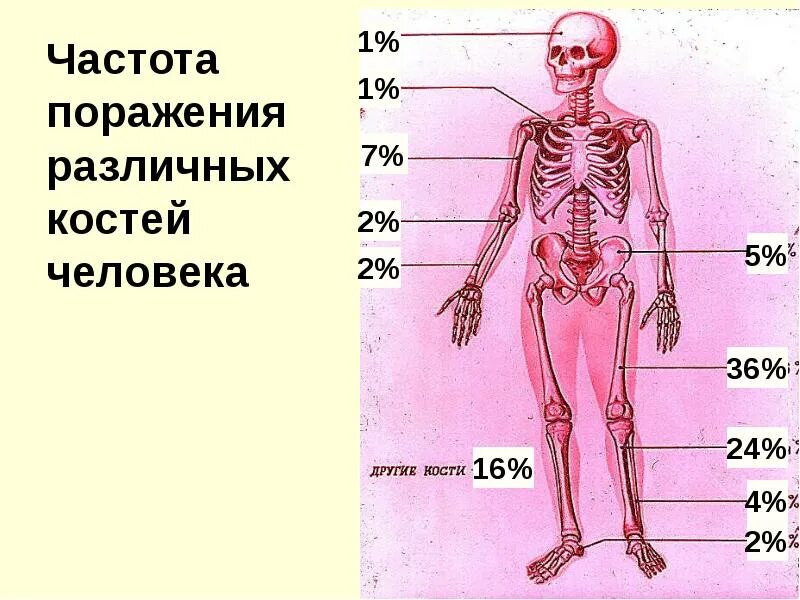 Частота поражения острым остеомиелитом различных костей. Частота поражения острым гематогенным остеомиелитом. Частота поражений костей остеомиелитом. С какой частотой обновляются кости