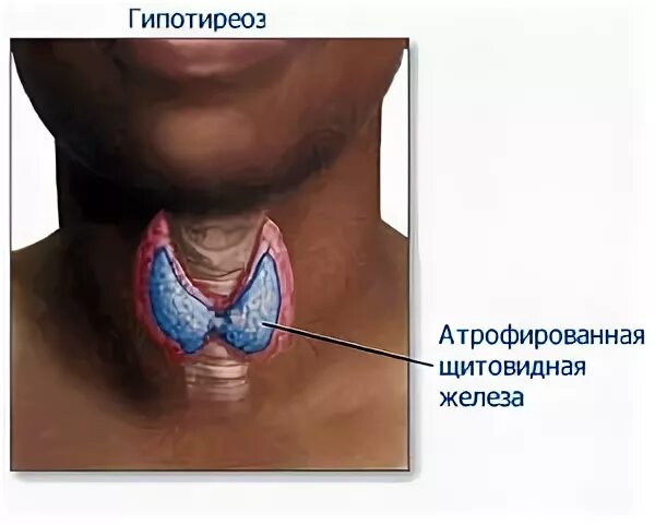 Гипотиреоз токсический зоб