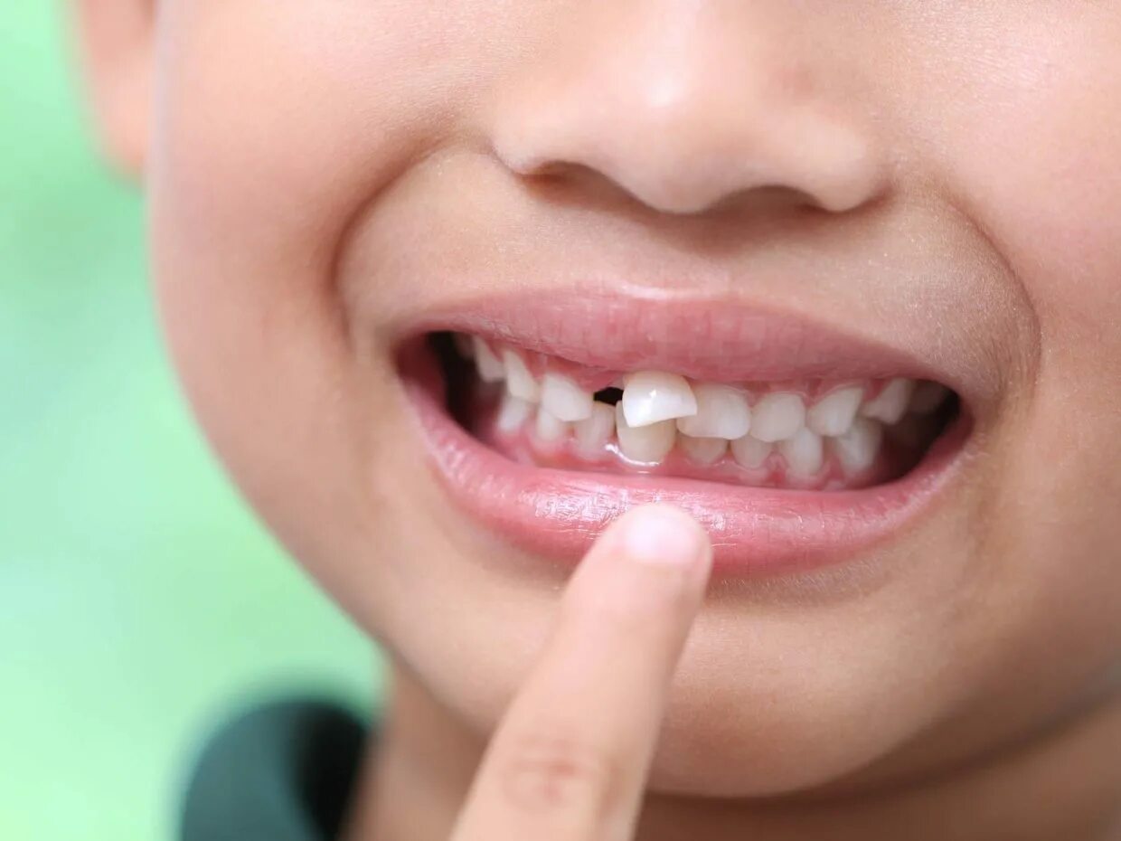 Поломанные детские зубы. У ребенка сломался молочный зуб. У ребенка сломался молочный зуб. Поломанные детские зубы. Выпадение молочных зубов.