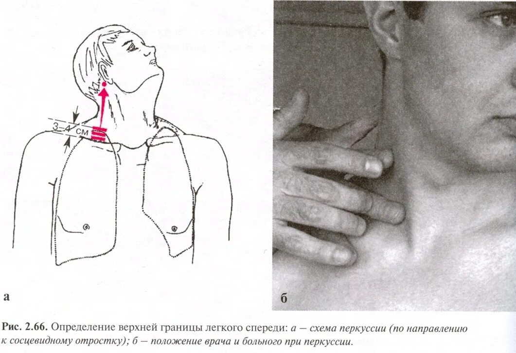 Топографическая перкуссия легких верхняя граница. Перкуссия Нижнего края легких. Топографическая перкуссия грудной клетки пропедевтика. Стояние верхушек легких норма