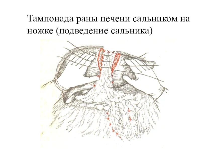 Тампонада раны при кровотечении. Тампонада раны сальником. Тампонада печени сальником.