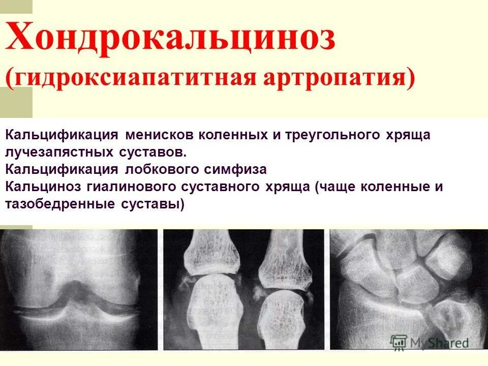 Артропатия лечение. Кальциноз коленного сустава рентген. Обызвествление менисков коленного сустава рентген. Пирофосфатная артропатия рентген коленного сустава. Хондрокальциноз и пирофосфатная артропатия.