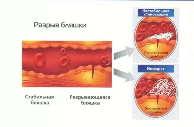 Разрыв атеросклеротической бляшки. Причины разрыва атеросклеротической бляшки. Отрыв атеросклеротической бляшки диагноз. Разрыв атеросклеротической бляшки патогенез. Тромб и бляшка разница