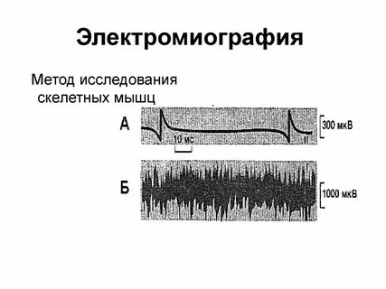 Электромиография принцип метода