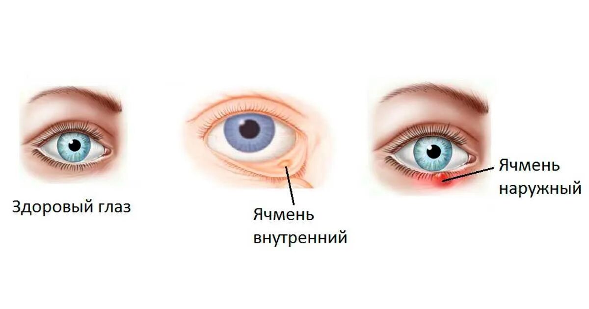 Ячмень на глазу как лечить быстро лекарствами. Ячмень внутреннего века.
