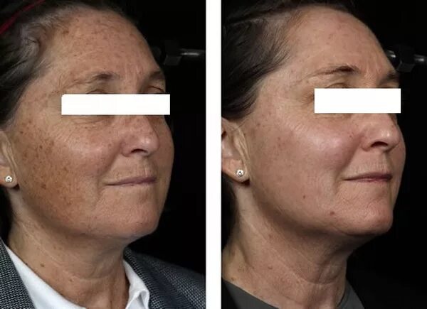 Лазерное удаление пигментных пятен. Фотоомоложение шлифовка кожи м22. лазерная деструкция пигментных пятен. фотоомоложение ipl от пигментных пятен. фототерапия от пигментных пятен.