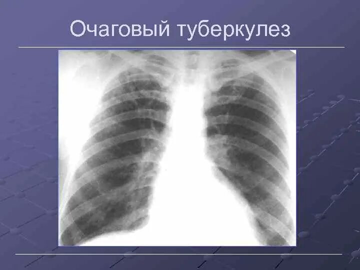 Очаговый туберкулез рентген. Очаговый туберкулез легких на рентгенограмме. Мягкоочаговый туберкулез. Очаговый туберкулез рентгенофлюорография. Фазы очагового туберкулеза