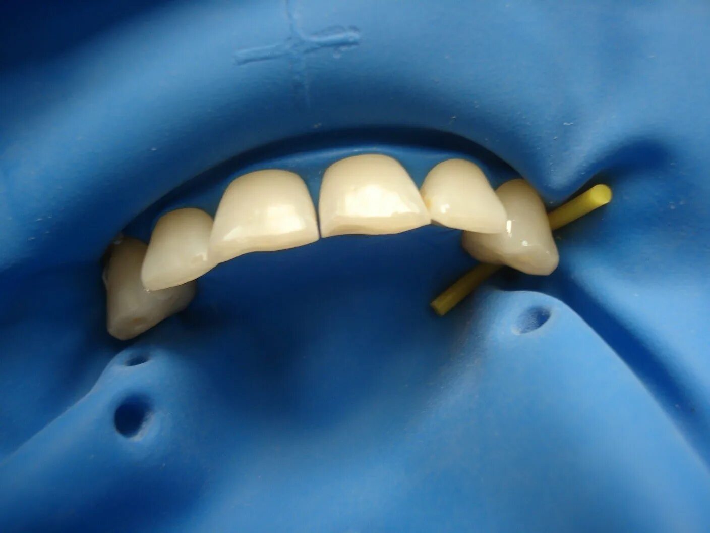 Коффердам (стоматология). Жидкий коффердам оптидам. Коффердам оптидам раббердам. Техника крыльев коффердам. Кофедрам.