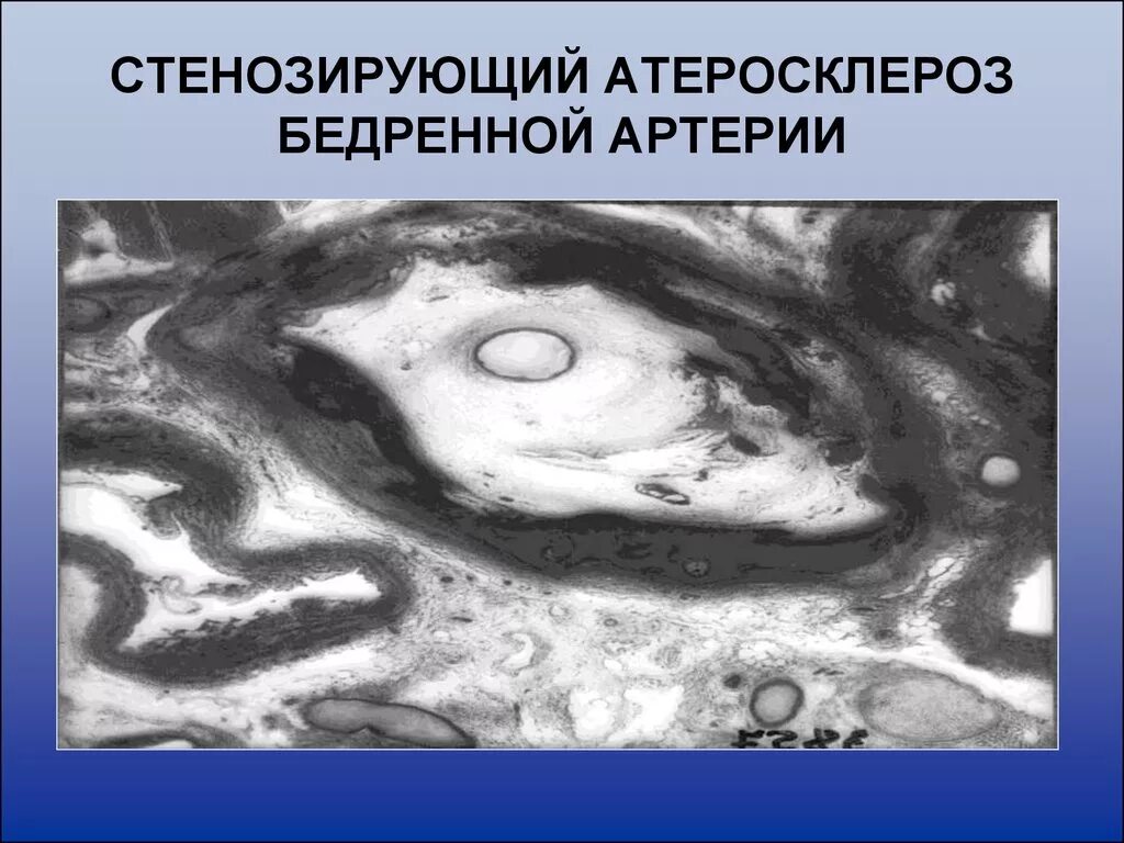 Стенозирующий атеросклероз бца что это такое простыми. Стенозирующий атеросклероз артерий. стенозирующий атеросклероз бедренной артерии. стенозирующий и нестенозирующий атеросклероз. нестенозирующий атеросклероз артерий.