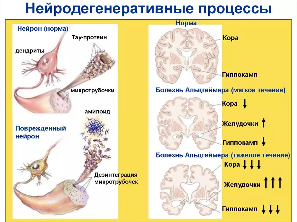 Нейродегенеративное заболевание головного. Нейродегенеративные заболевания. Нейродегенеративное заболевание ЦНС. Нейродегенеративное заболевание головного мозга. Нейродегенеративные процессы.