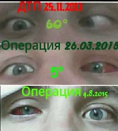 Почему двоится в глазах в даль. Двоение в глазах. глаз после операции на косоглазие. капли в глаза после операции косоглазия. бинокулярная диплопия.