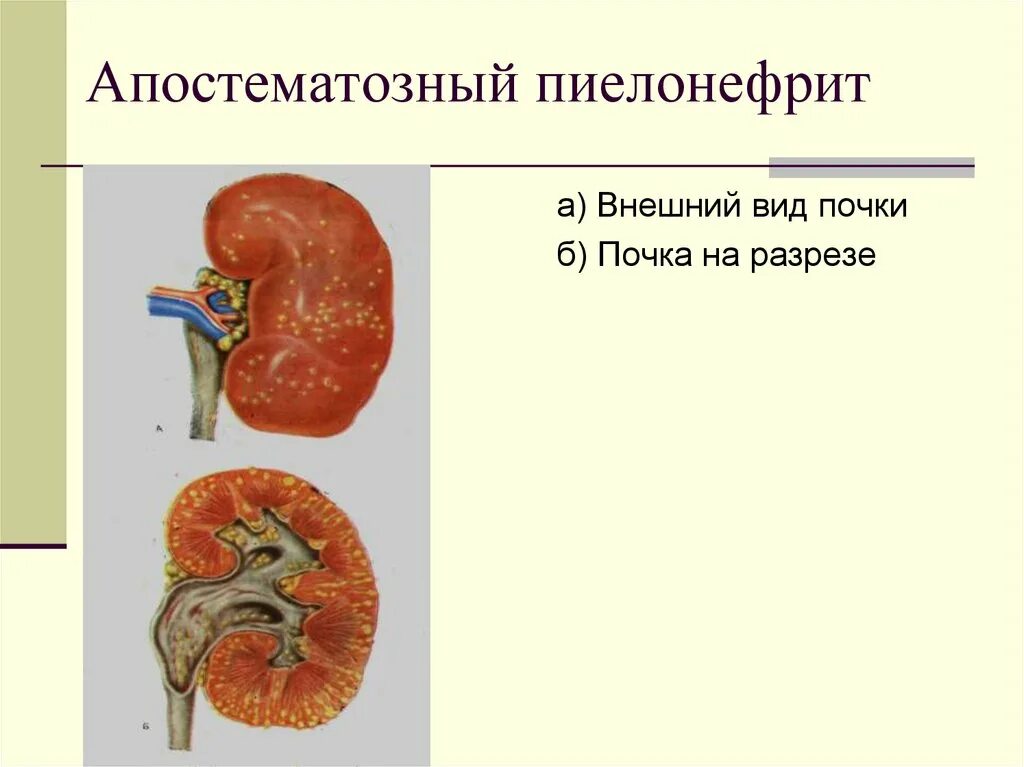 Кт почек хронический пиелонефрит. Апостематозный пиелонефрит патанатомия. Апостематозный пиелонефрит почка. Пиелонефрит Гнойный апостематозный.