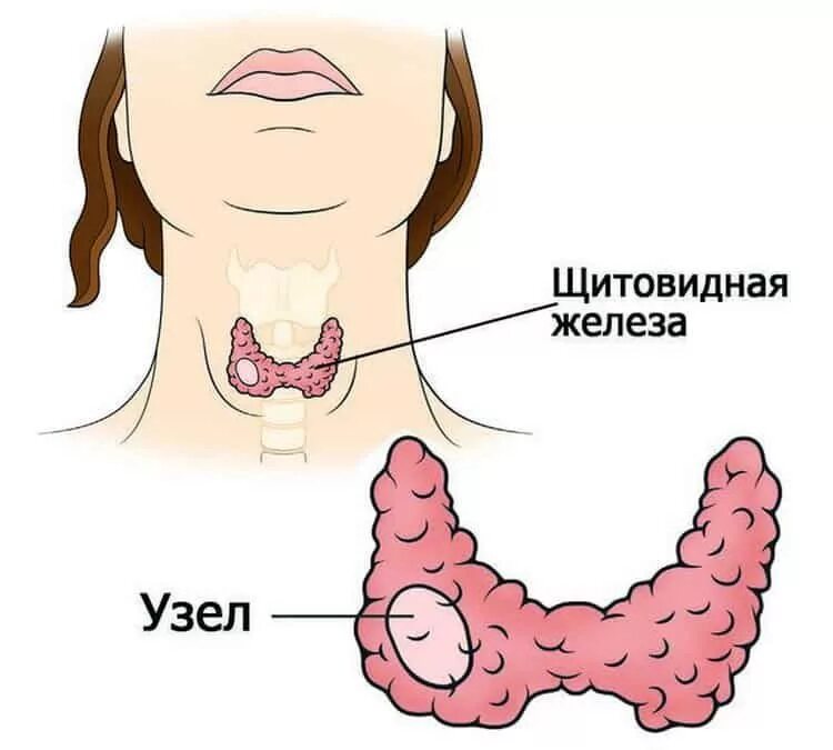 Почему образуются узлы. Узловые образования щитовидной железы. Узлы ВЩ итов дной железе. Узлы в щитовидной железе. Узлы на щитовидной железе железа.