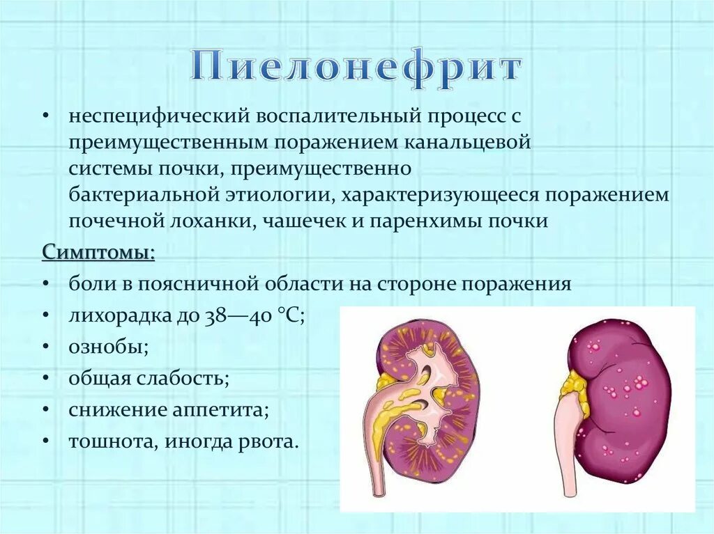 Признаки пиелонефрита почек. Строение почки пиелонефрит. Необструктивный хронический пиелонефрит. Пиелонефрит заболевание органов мочевыделительной системы. Пиелонефрит характеризуется воспалением.