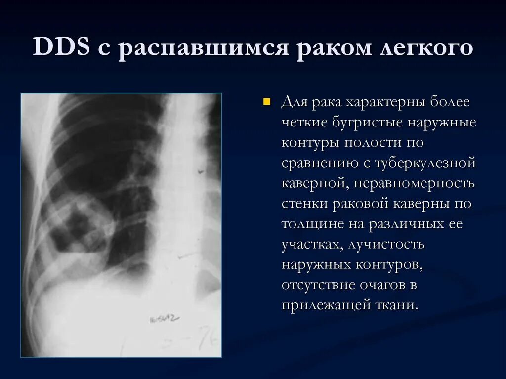 Признаки периферического легкого. Опухоль с распадом на рентгене. Распадающиеся опухоли легких. Периферическая опухоль легкого. Раковая опухоль рентген.