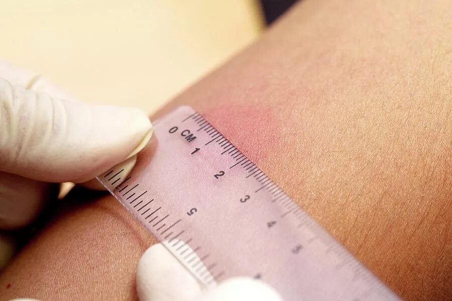 Прививка реакция диаскинтест. Манту реакция норма аллергическая. Иммунодиагностика туберкулеза диаскинтест. Как выглядит тест на туберкулез. Диаскинтест на туберкулез положительный.