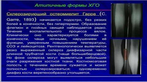 Остеомиелит мкб 10 у взрослых