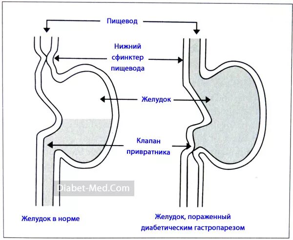 Клапан между желудком и пищеводом. Клапан желудка не закрывается. Верхний и Нижний клапан пищевода. КЛАМАН меж желудком и пищеводом.