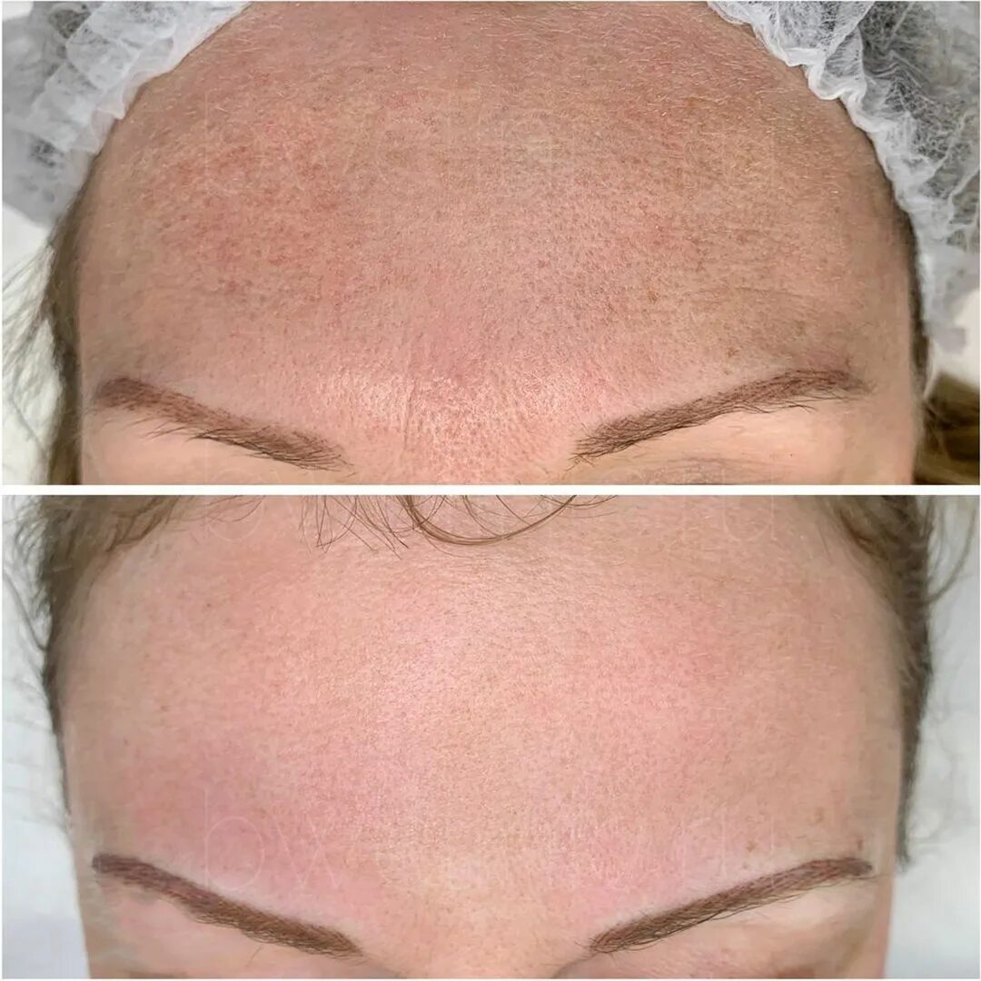 Алмазная шлифовка лица от постакне. Пилинг. Косметология фон. Школа массажа панфилова сертификат. Ультразвуковой пилинг лица.