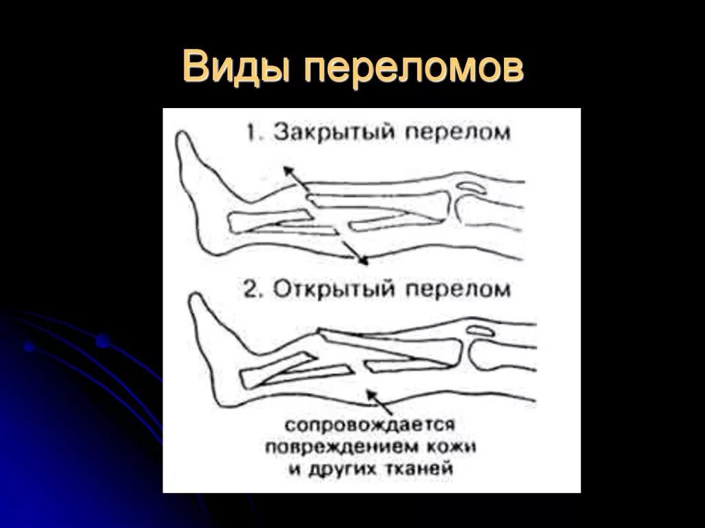 Степени открытого перелома. Типы закрытых переломов. Открытый и закрытый перелом.