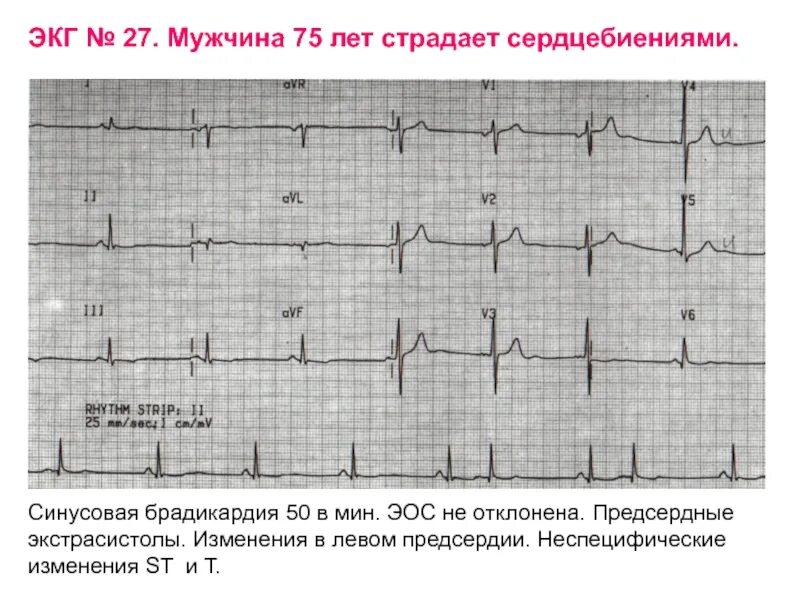 Синусовая брадикардия на экг. Брадикардия эос. Вертикальная эос сердца на экг что это. Экг при синусовой брадикардии сердца. Брадикардия эос.