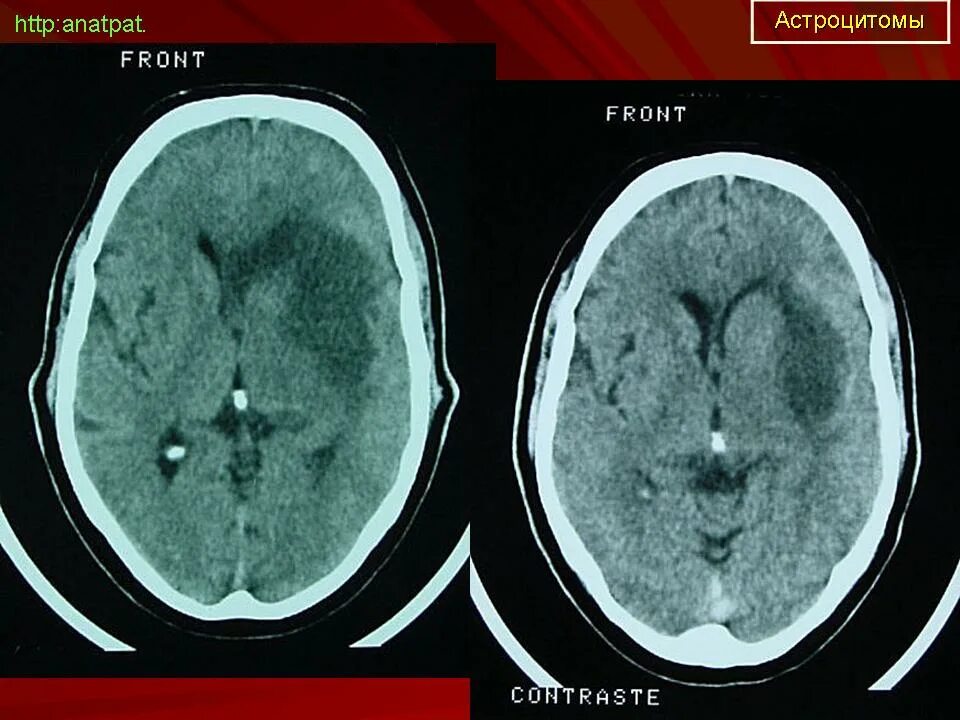 Астроцитома головного мозга прогноз. Мультифокальная астроцитома. Астроцитома доброкачественная. Пилоцитарная астроцитома. Астроцитома головного мозга кт.