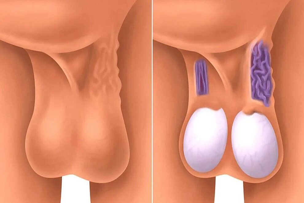 Ниже яиц у мужчин. Варикоцеле-расширение вен семенного канатика яичка. Варикоз вен семенного канатика. Варикозное расширение вен семенного канатика II степени.