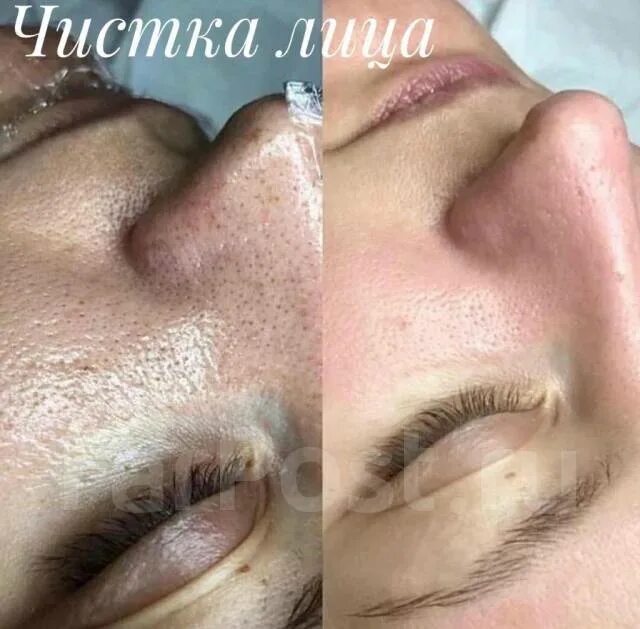 Делать ли чистку перед пилингом. Делать ли чистку перед пилингом
