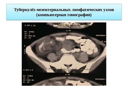 Мезаденит у детей лечение