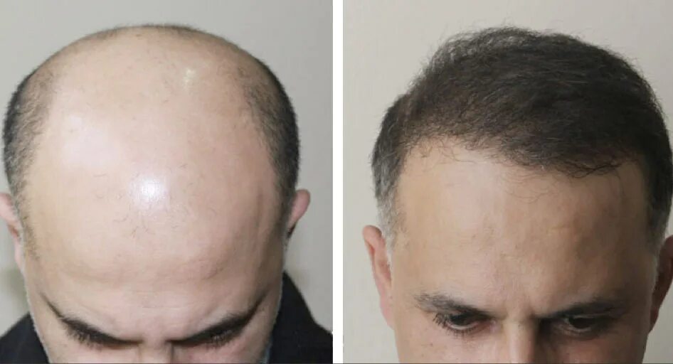 Пересадка волос красноярск. Миноксидил лысина до и после. Миноксидил алопеция головы.