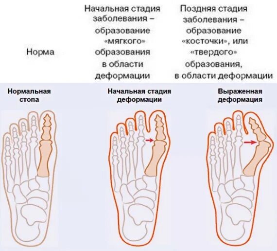 Как выглядит косточка на ногах Гигрома кисти / лучезапястного сустава Лечение гигром в Москве ✓ Клиника подолог