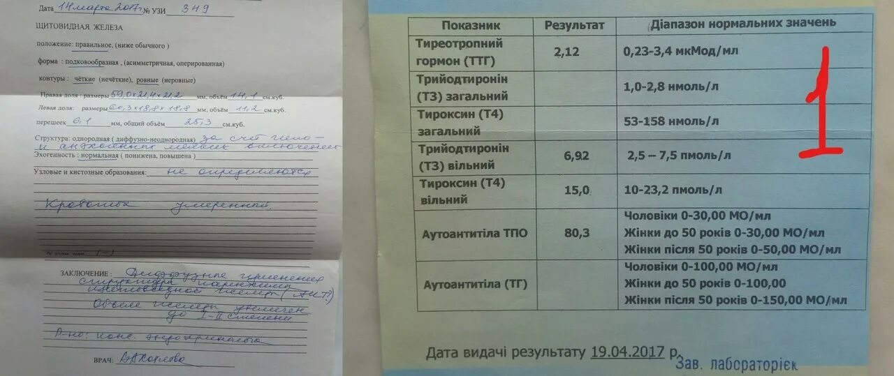 Расшифровка анализов на щитовидную железу у женщин. Анализ АТПО щитовидной железы. АТПО щитовидной железы норма. Антитела к пероксидазе щитовидной железы. Анализы на гормоны щитовидной железы антитела.