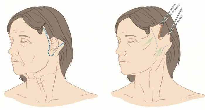Смас лифтинг схема операции. Операция смас лифтинг операция. Разрезы при круговой подтяжке лица. Лифтинг лица. Схема подтяжки лица