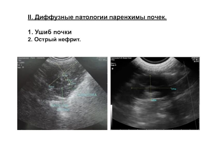 Диффузная почка что это значит. УЗИ почек острый тубулоинтерстициальный нефрит. Диффузные изменения паренхимы почек на УЗИ. Нефрит УЗИ признаки.