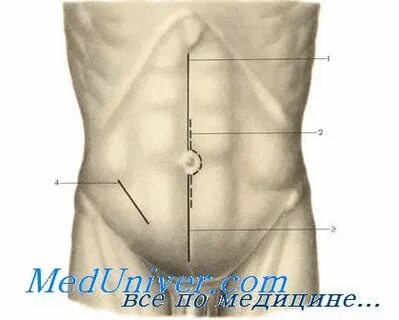 Лапаротомия ревизия