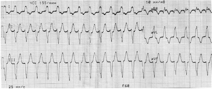 Тахикардии широким qrs. Тахикардия с широкими комплексами qrs на экг. желудочковая тахикардия с широкими комплексами на экг. наджелудочковая тахикардия с широкими комплексами на экг. пароксизмальная тахикардия с широким комплексом qrs на экг.