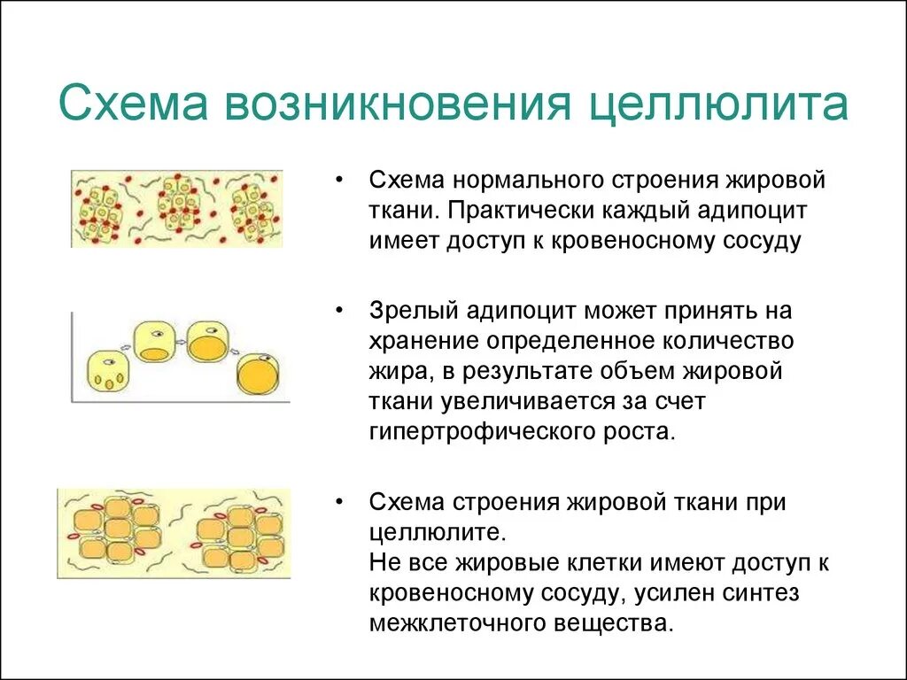 Схема возникновения целлюлита. Жировая ткань схема. Целлюлит механизм образования. Целлюлит строение жировой ткани. Изменения происходящие в жирах