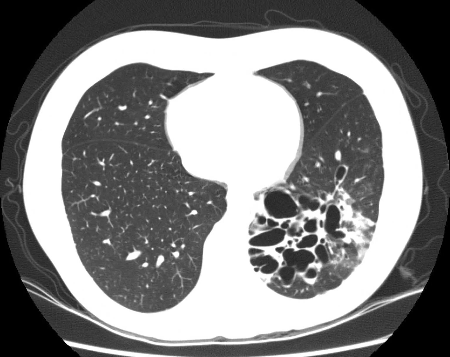 Мешотчатые бронхоэктазы на кт. Кт при бронхоэктатической болезни. Бронхоэктатическая болезнь легких на кт. Бронхоэктатическая болезнь кт картина. Полость заболевания легких
