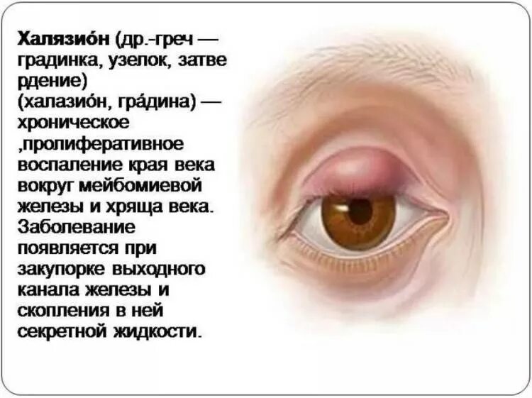 Можно ли лечить ячмень. Заболевание глаз халязион век. Халямзик.