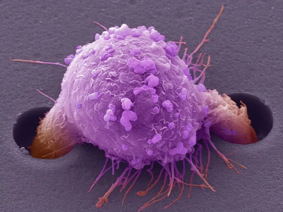 Steve Gschmeissner Cell. Раковые клетки под микроскопом. Клетки раковой опухоли под микроскопом. Питание раковой клетки