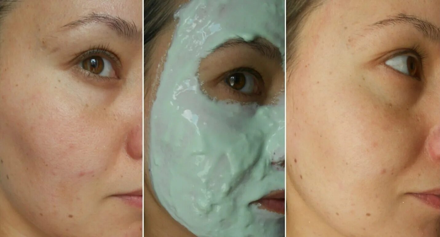 Альгинатные маски до после. Альгинатные маски для лица до и после. Альгинатные маски эффект до и после.