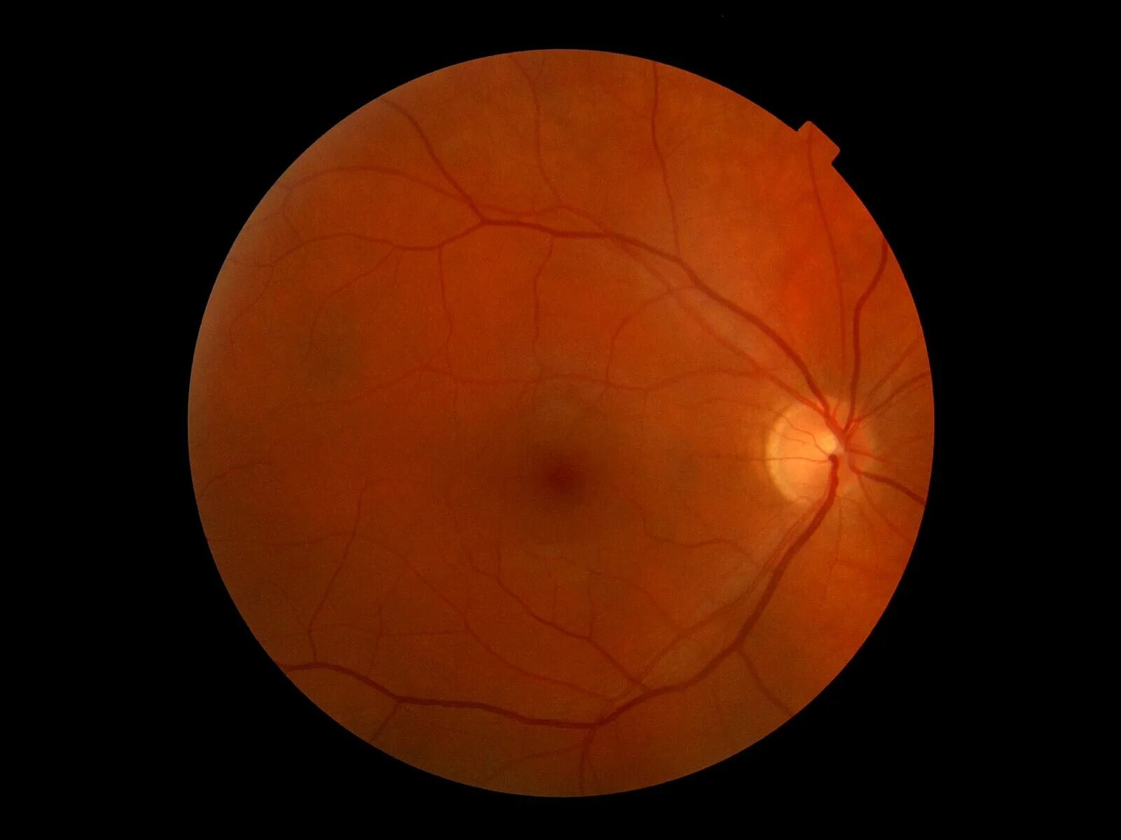 Hypertensive retinopathy - Wikipedia