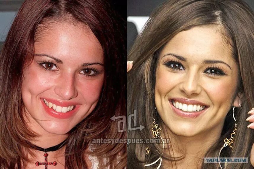 Сколько стоят зубы звезд. Майли сайрус виниры. Сколько стоят зубы звезд. Шерил коул зубы до и после. Виниры у звезд.