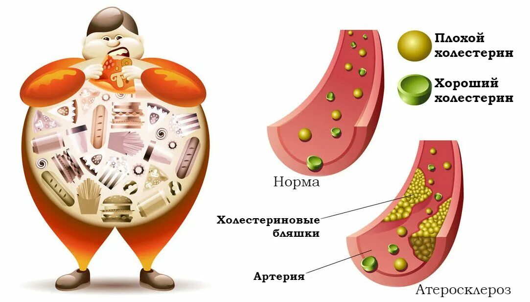 Ожирение и атеросклероз. Ожирение и атеросклероз
