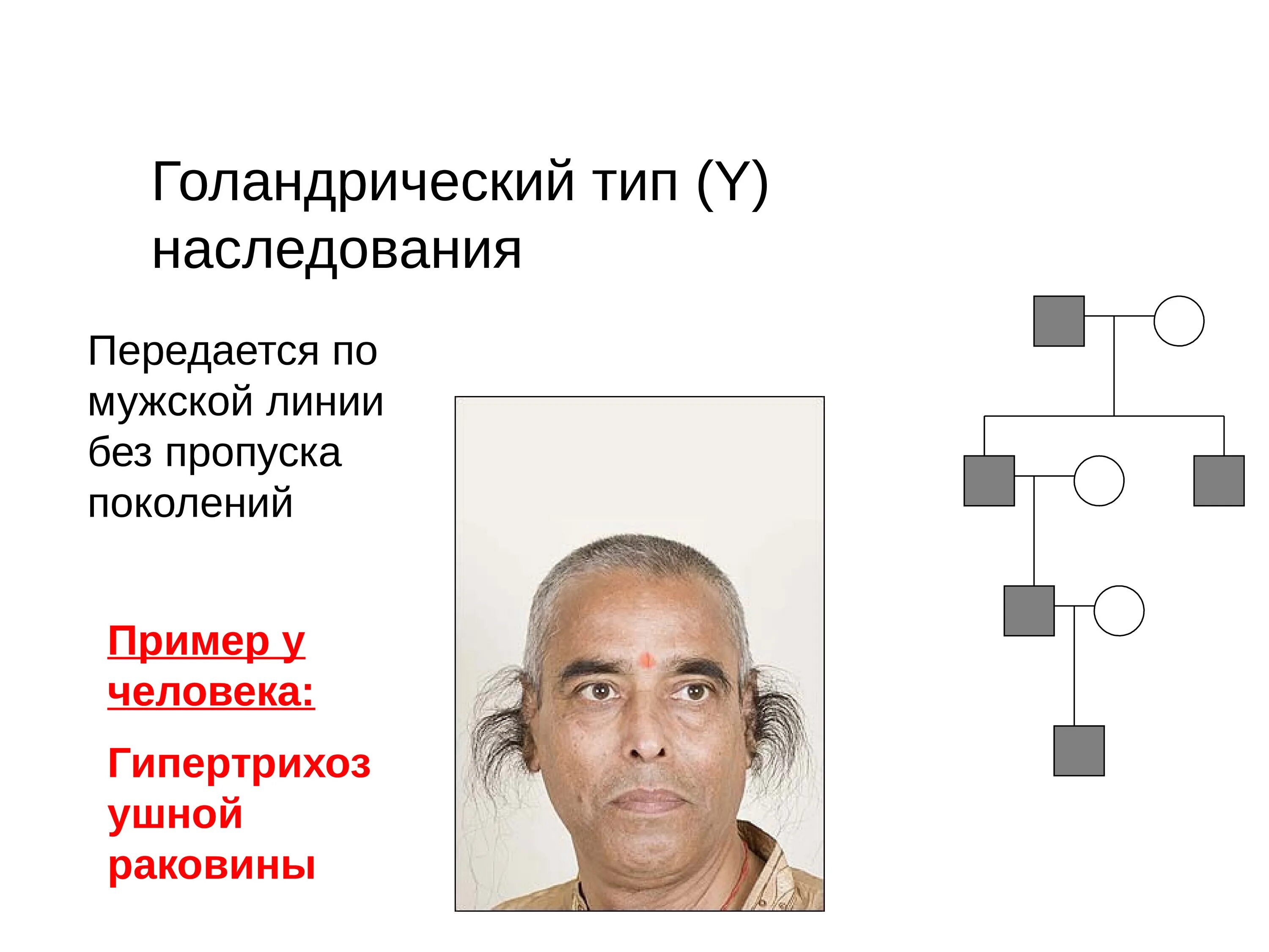 Сцепленные заболевания примеры. Y-cцепленный (голандрический) Тип наследования. Гипертрихоз голандрический Тип наследования. Гипертрихоз ушной раковины Тип наследования. Y-сцепленный Тип наследования болезни.