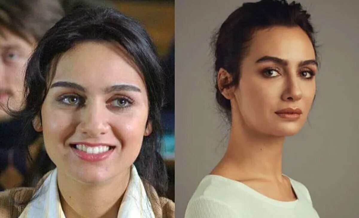 бирдже акалай. турецкие актрисы до и после пластики. фахрие эвджен до и после пластики. неслихан атагюль блефаропластика. актриса неслихан атагюль.