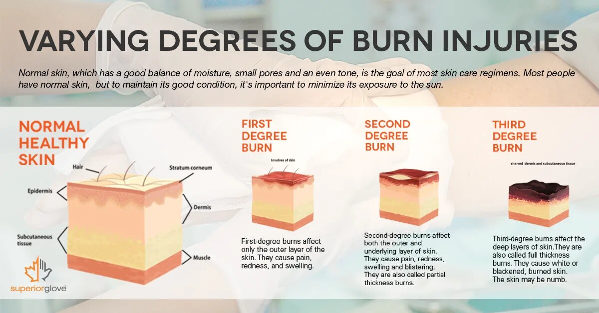 How did you burn. How did you burn