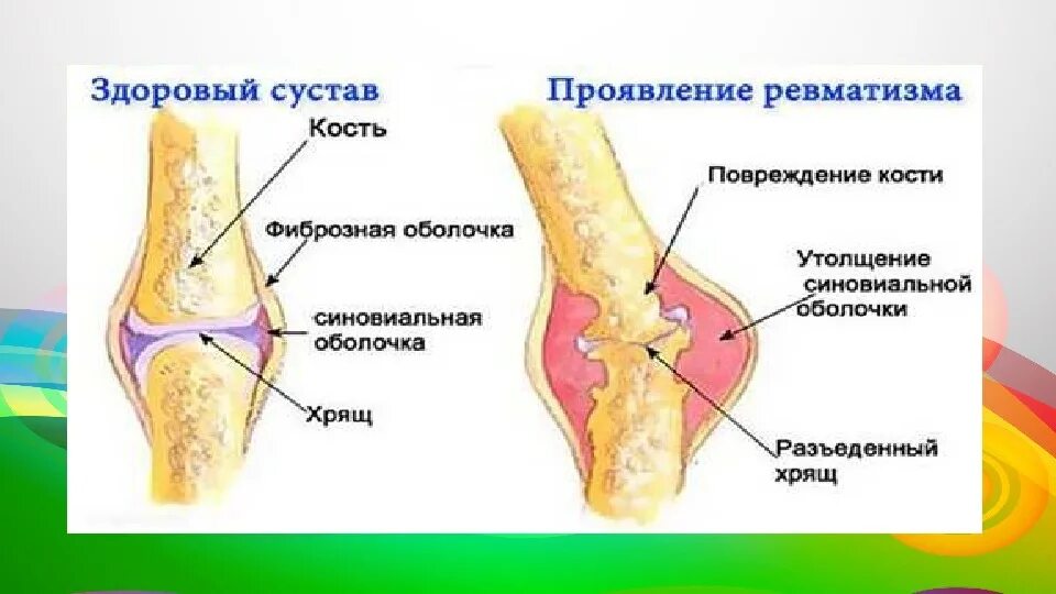 Ревматическое поражение суставов. Ревматизм суставов симптомы.