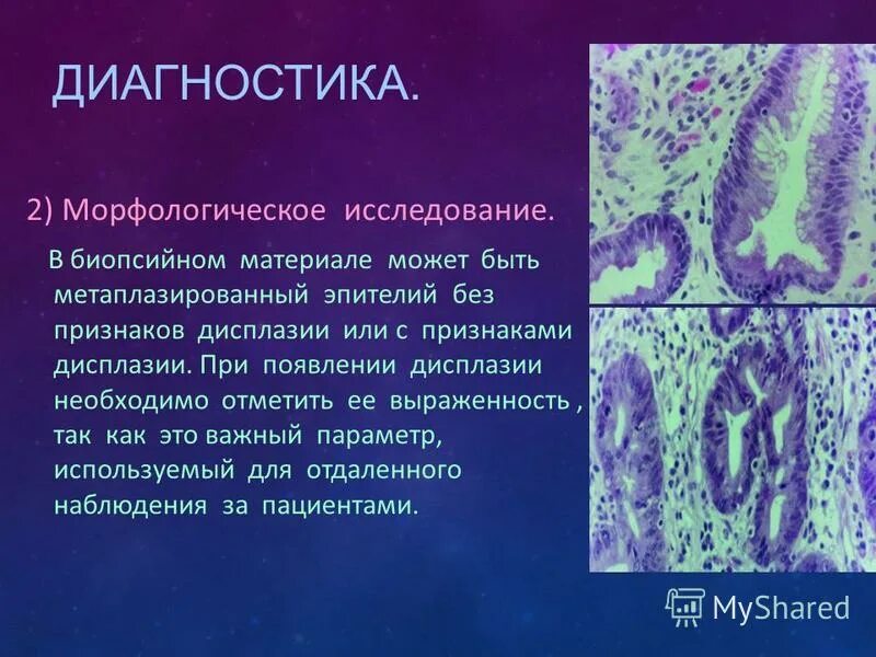 плоскоклеточная метаплазия эпителия. группы метаплазированного эпителия. Nilm, плоскоклеточная метаплазия железистого эпителия. метаплазия эпителия слизистой оболочки бронха. эпителий бронхов микропрепарат.
